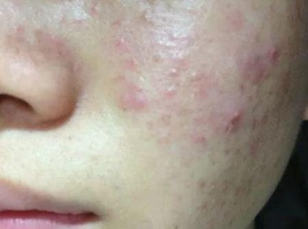 ��������ë���׳��ֶ࣬�ൺƤ����ҽԺë���׵�5�����η�ʽ
